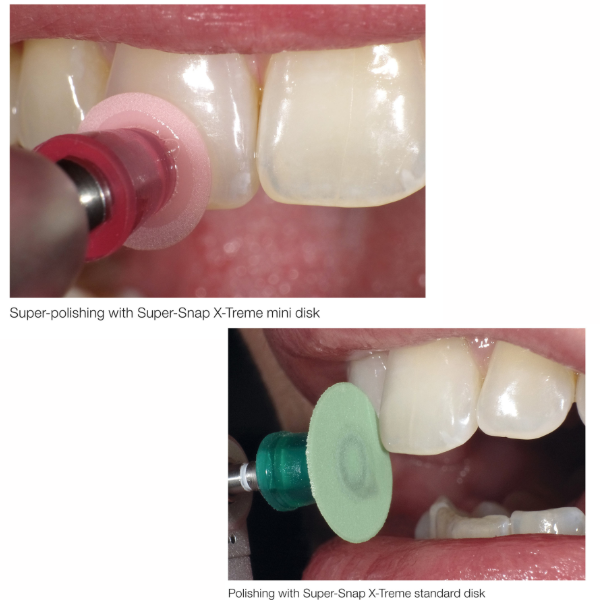 Shofu Super Snap X-Treme Technique Kit - Vijai Dental